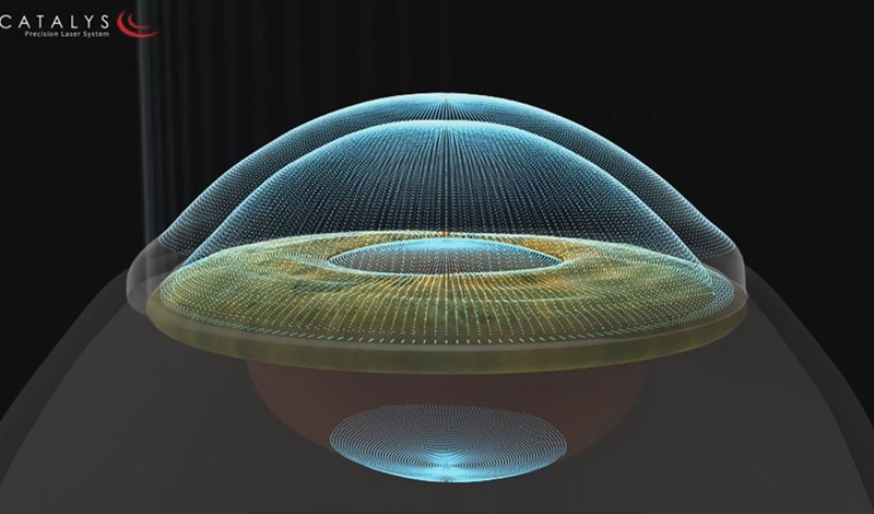 1万本のA scanレーザーが眼球の３次元立体構造を解析