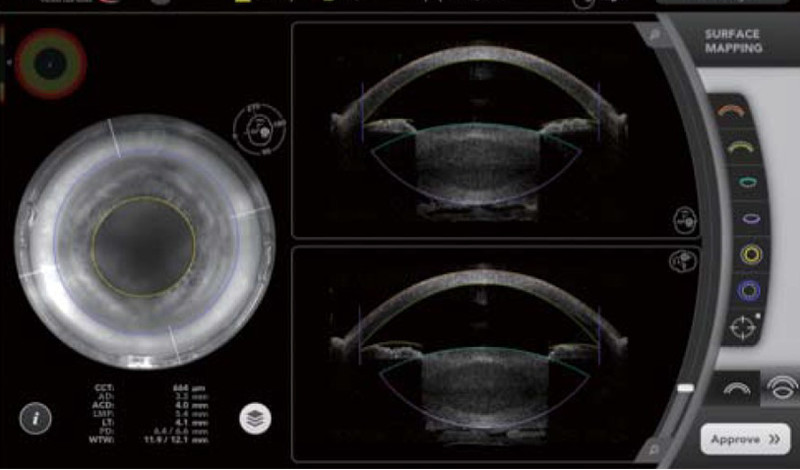 フルボリュームOCT機能が個人の眼の構造を再構築